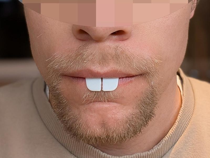 Rabbit teeth