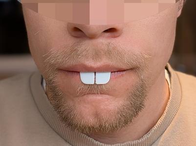 Rabbit teeth