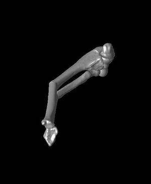 Both bone malunion sag 40 degrees.stl