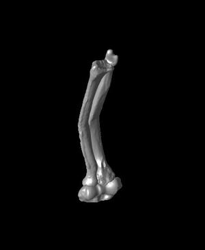 Both bone malunion sag 15 degrees.stl