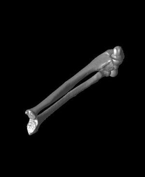 Both bone malunion sag 10 degrees.stl