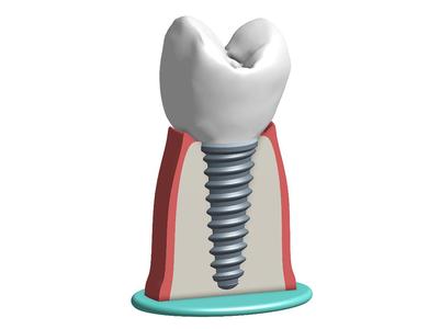 Tooth implant model