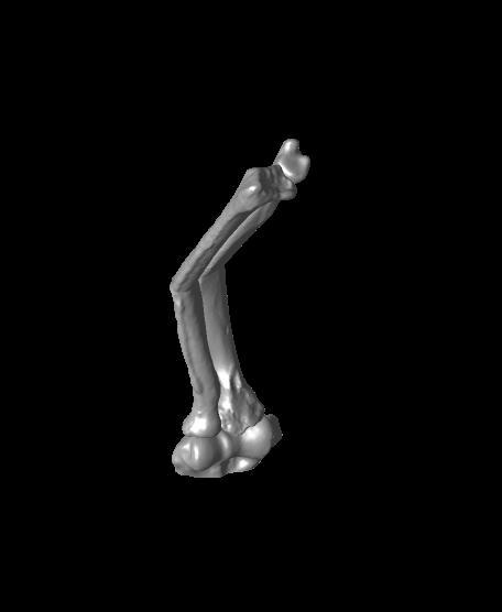 Both bone malunion sag 30 degrees.stl