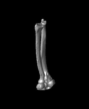 Both Bone no malunion.stl
