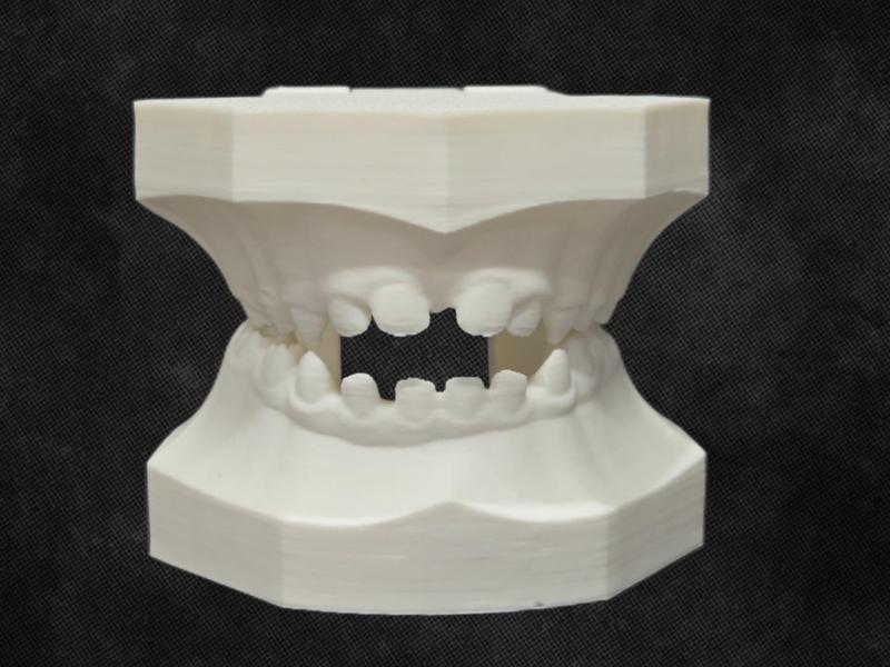 Pediatric Dental Typodont—Open and Cross Bites