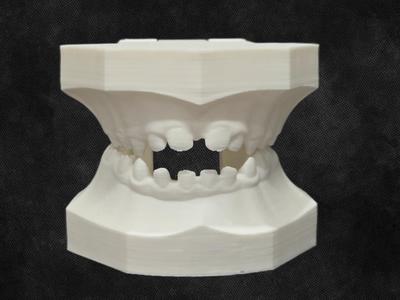 Pediatric Dental Typodont—Open and Cross Bites