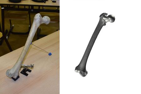 Thigh Bone Scan - Femur