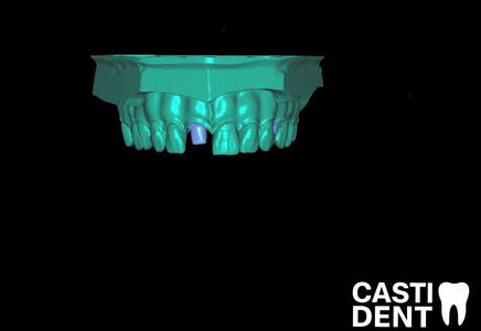 Tooth Preparation Models – Central, Premolar, Molar | Cut-back, Training & Wax-up