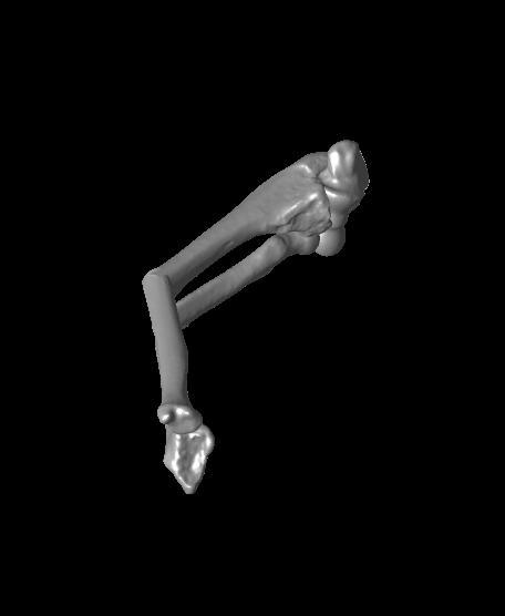 Both bone malunion sag 50 degrees.stl