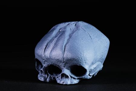 Conjoined Fetal Skull