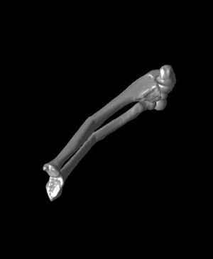Both bone malunion sag 20 degrees.stl