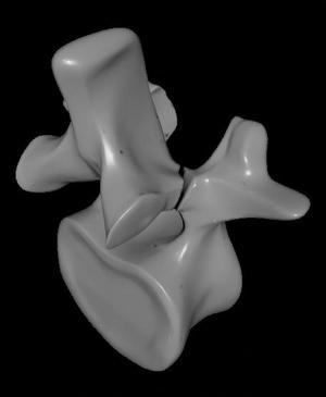 Pars Fracture Spondylolysis