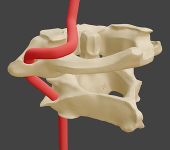 Atlas and Axis (C1 and C2) Cervical Vertebrae